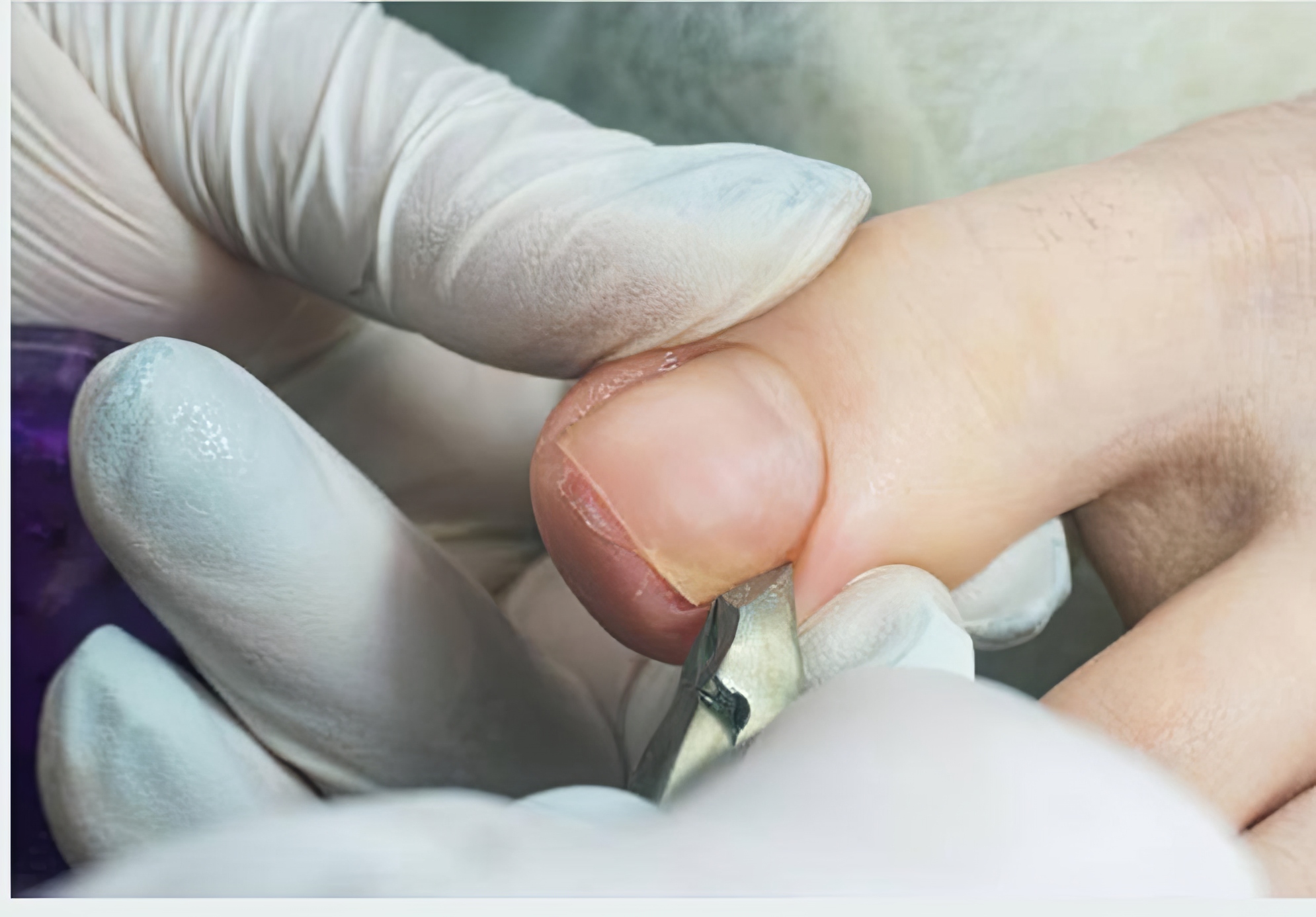 Ονυχομυκητίαση