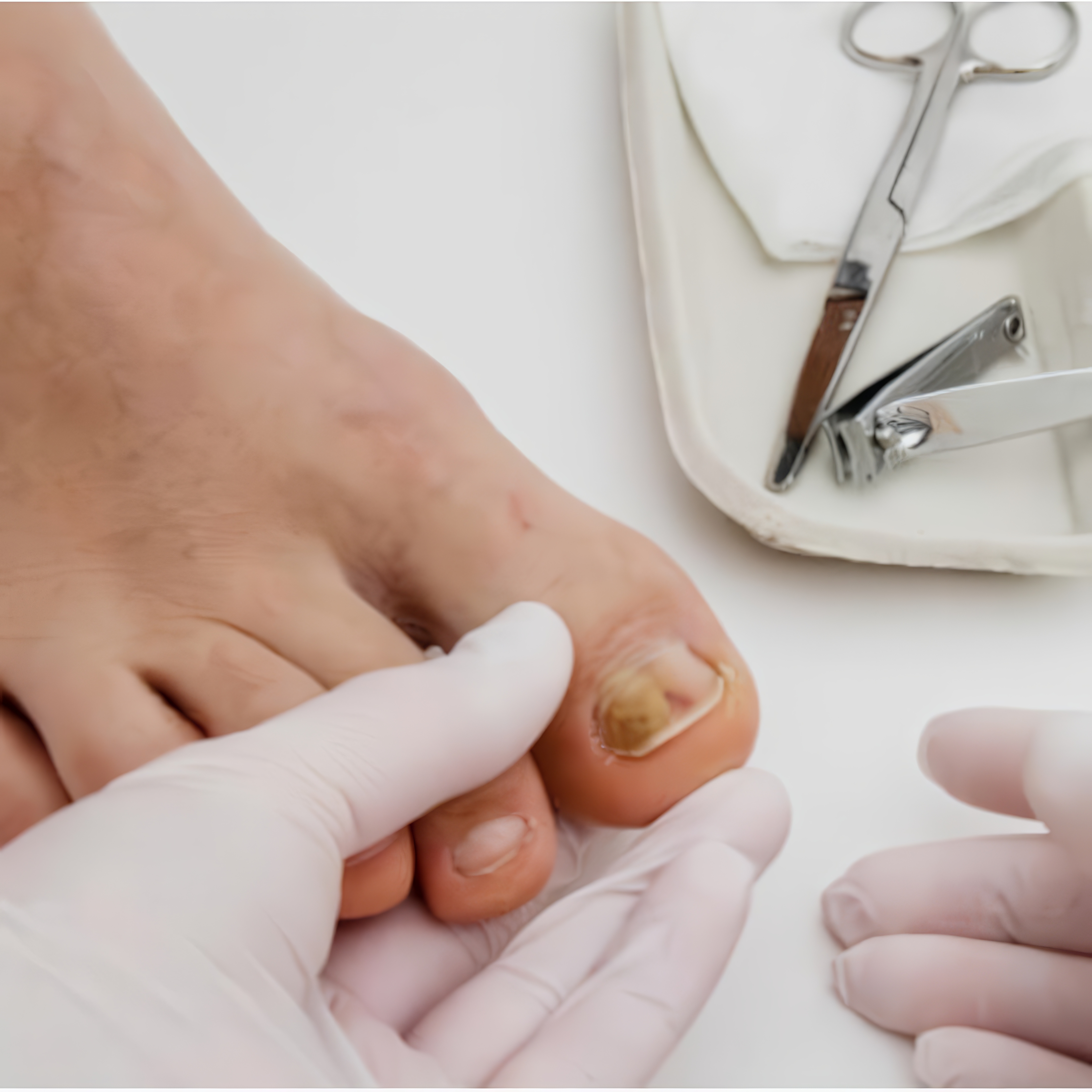 Ονυχομυκητίαση